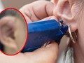 Bệnh nhân bị biến chứng do bấm lỗ tai sai vị trí, không đảm bảo vệ sinh