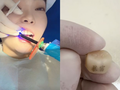 Một khách hàng trẻ đang làm thủ thuật "xăm răng" với hai chữ "Bạo phú" (Giàu nhanh). Ảnh: Orientaldaily.
