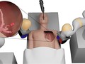 Robot mềm xúc tu từ tính phẫu thuật khối u phổi ngoại biên vùng não trước. Ảnh Đại học Leeds.