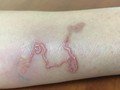 "Đường hầm" do ấu trùng giun chó mèo "đào" dưới da