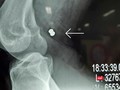 Phim X-ray chụp viên đạn ghim vào đùi gây vở động mạch và tĩnh mạch đùi của bạn nhân