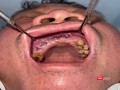 Bệnh nhân sau khi được phẫu thuật điều trị (ảnh bệnh viện cung cấp)
