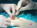 Ca phẫu thuật cắt bỏ khối sùi mào gà dương vật cho bệnh nhi 6 tuổi, giúp bệnh nhân tránh nguy cơ cắt cụt dương vật.