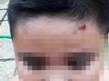 Cháu bé bị bắn sượt vào đầu.