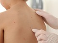 Các nốt phỏng nước nổi khắp cơ thể là biểu hiện điển hình của thủy đậu