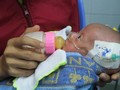 Em bé sơ sinh mới chỉ 1,6 kg đã được cứu cống sau 2 ca phẫu thuật tim "nghẹt thở"