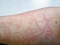 Bệnh lý da vẽ nổi rất hay gặp ở trẻ em, đặc biệt trong mùa mưa (ảnh minh họa)