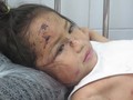 Bé Nguyễn Trần Sa Ny (5 tuổi) thoát chết trong vụ sạt lở núi nhưng trầy xước khắp người. Ảnh: Xuân Hiển