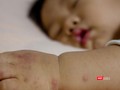 Bệnh tay chân miệng có nhiều biến chứng nguy hiểm. Ảnh: Bệnh viện Đa khoa Tâm Anh