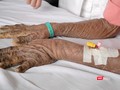 Hai tay của một nạn nhân nhiễm độc thuốc nam điều trị tại Bệnh viện Chợ Rẫy