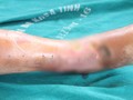 Chân của bệnh nhân bị hoại tử vì tự ý chữa tại nhà