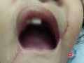 Tổn thương vùng miệng của bé T. đã được các bác sĩ xử trí.