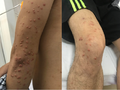 Các nốt sần đặc nhân vàng nổi dày đặc trên tay và chân của anh K.