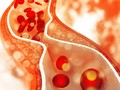 Có quá nhiều cholesterol trong máu ảnh hưởng lớn tới sức khỏe tim mạch.