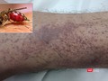 Bệnh nhân bị xuất huyết nặng dưới da do mắc sốt xuất huyết trên nền bệnh tan máu bẩm sinh.