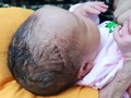Vừa mới ra đời, em bé này đã phải chịu vết khâu dài 6 mũi.