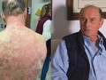 Ông Richard Terrell bị phát ban toàn thân sau khi tiêm vaccine Covid-19 của Johnson & Johnson. Ảnh: Richmond News.