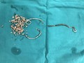 Đoạn stent jj gãy và sỏi lấy ra khỏi cơ thể bệnh nhân