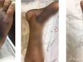 Chân của bệnh nhân bị nhiễm trùng máu nặng do loài vi khuẩn lạ (Ảnh: BVCC) 