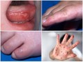Hình ảnh trẻ mắc tay chân miệng (Ảnh: Bệnh viện Nhi Trung ương)
