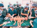Gần 100 y, bác sĩ đang tiến hành phẫu thuật tách rời cặp song sinh Trúc Nhi – Diệu Nhi (Ảnh: Bệnh viện Nhi đồng Thành phố - TP. Hồ Chí Minh)