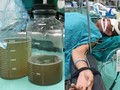 Dùng miệng hút dầu chạy máy xúc, bệnh nhân rơi vào tình trạng suy hô hấp, viêm phổi nặng