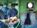 Tiến hành nội soi tái tạo 3 dây chằng khớp gối cho bệnh nhân trong cùng một cuộc phẫu thuật