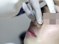 Biến chứng do thẩm mỹ tăng: Người hành nghề không có chuyên môn