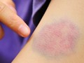 Vết bầm tím trên da cảnh báo bệnh gì?