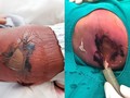 Em bé sơ sinh bị bỏng nặng, hoại tử da vì mẹ cho nằm than