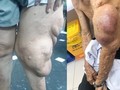 Cắt bỏ khối u sợi thần kinh khổng lồ khỏi cơ thể người đàn ông.