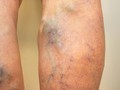 Đừng chủ quan với bệnh suy giãn tĩnh mạch. Ảnh: Medicalnewstoday