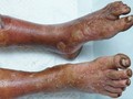 Hoại tử cả 2 chân vì ngâm bằng loại bột lá không xuất xứ