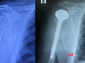 Phim chụp khớp vai của bệnh nhân trước và sau phẫu thuật