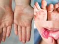 Bệnh tay chân miệng ở trẻ em (ảnh SKĐS)