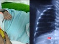 Em bé D.A bị dị dạng đường dẫn khí phổi bẩm sinh