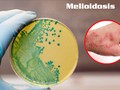 Ảnh minh họa bệnh Melioidosis (hay còn gọi là bệnh Whitmore).