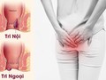Trĩ gây ảnh hưởng tới sinh hoạt hàng ngày của người bệnh.