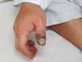Ngón cái bàn tay phải của bệnh nhân bị rắn cắn sưng đỏ, có dấu hiệu hoại tử. Ảnh: BVCC