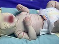 Bé trai sinh non 34 tuần bị mọc sừng khắp cơ thể (Ảnh: Bệnh viện Sản Nhi Quảng Ninh) 