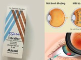 Hậu quả đáng sợ khi tự ý sử dụng thuốc Tobradex