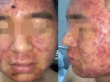 Nam thanh niên 22 tuổi “cầu cứu” bác sĩ vì mụn mọc kín mặt 