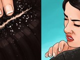 Những cách trị gàu đơn giản, ít tốn kém mà hiệu quả bất ngờ