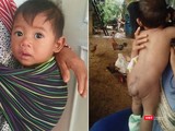 Bé trai 7 tháng tuổi người dân tộc Châu Mạ mang khối u khổng lồ ở mông