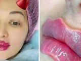 “Cặp môi của quỷ” – Trào lưu làm đẹp kỳ dị đang lây lan và lời cảnh báo đáng sợ