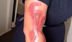 Bỏng tay vì iPhone 7 quá nóng.