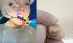 Một khách hàng trẻ đang làm thủ thuật "xăm răng" với hai chữ "Bạo phú" (Giàu nhanh). Ảnh: Orientaldaily.