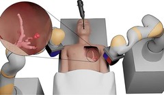 Robot mềm xúc tu từ tính phẫu thuật khối u phổi ngoại biên vùng não trước. Ảnh Đại học Leeds.