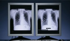 Ung thư phổi là loại bệnh phổ biến nhất trên toàn thế giới, ước tính có 2,5 triệu ca mới trên toàn cầu vào năm ngoái. Ảnh: PR NEWSWIRE.