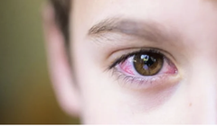 Dịch đau mắt đỏ đang bùng phát 